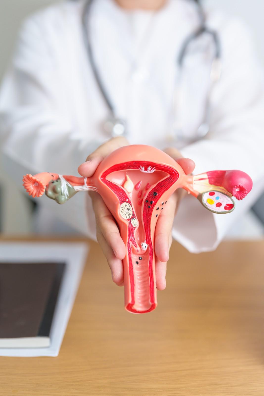 endometriosis